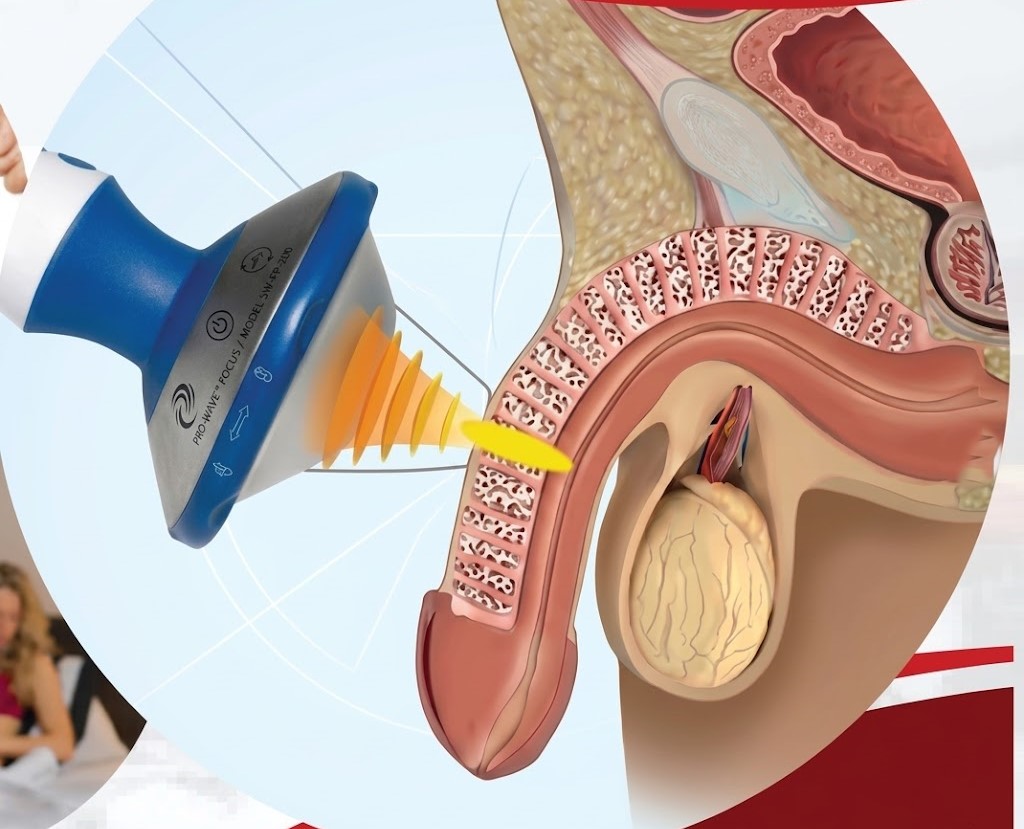 Shockwave Therapy For Erectile Dysfunction